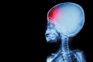 Undiagnosed Brain Injuries From Childhood