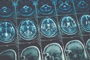 The Different Types of Traumatic Brain Injury