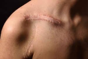 Scarring and Disfigurement in an Injury Lawsuit