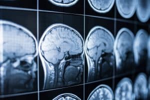 Misconceptions About Traumatic Brain Injuries